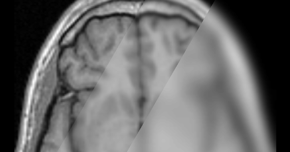 Gaussian Smoothing applied to a MR Image of a brain.