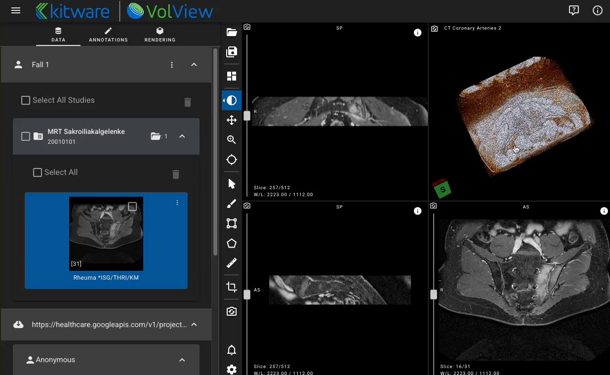 screenshot of VolView with medical imaging on it.