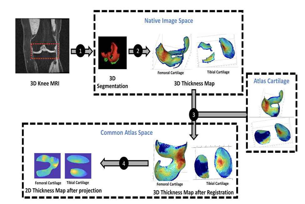 The pipeline starts with the ingestion of patient knee MRI scans. After ingestion, the data undergoes several preprocessing steps, including image reading and reorienting, intensity normalization, and cartilage segmentation using deep learning. It then registers patient images to an atlas for alignment, followed by transforming patient meshes of femoral and tibial cartilage into the atlas space, bisecting them into inner and outer surfaces, and calculating cartilage thickness based on the distance between the surfaces. The pipeline concludes by projecting the atlas mesh to 2D for further analysis. Each of these steps produces intermediate results, allowing for flexibility, easy debugging, and (in the future) reusability.