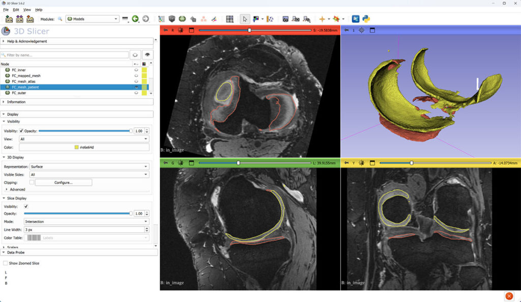 Grayscale: magnetic resonance image. Yellow: femoral cartilage (FC) surface. Red: tibial cartilage (TC) surface.