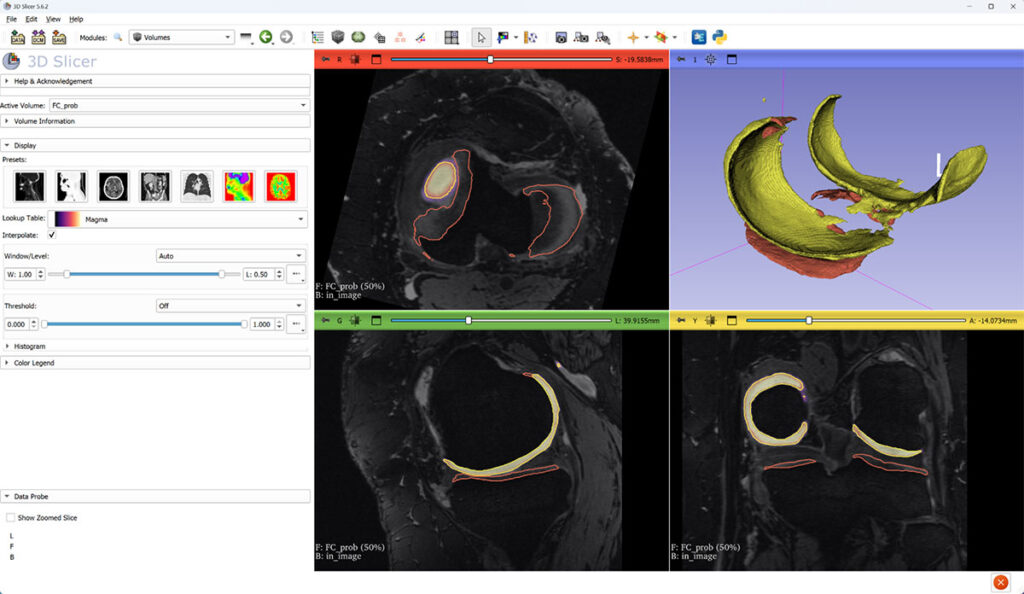 Femoral cartilage probability overlaid on top of MRI. FC and TC surfaces are constructed at 50% threshold of probability image.