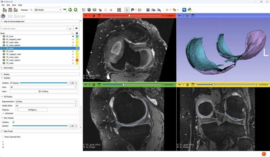 After island filtering, cartilage meshes are split into inner (blue) and outer (purple) parts, and their mutual distance is interpreted as cartilage thickness.