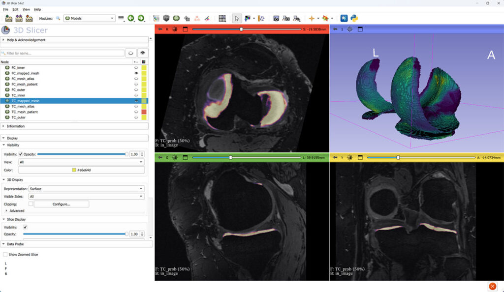 Thickness is computed for each vertex of the “outer” surface part and then mapped to a canonical atlas mesh (3D view). Slice views show tibial cartilage probability on top of MRI.