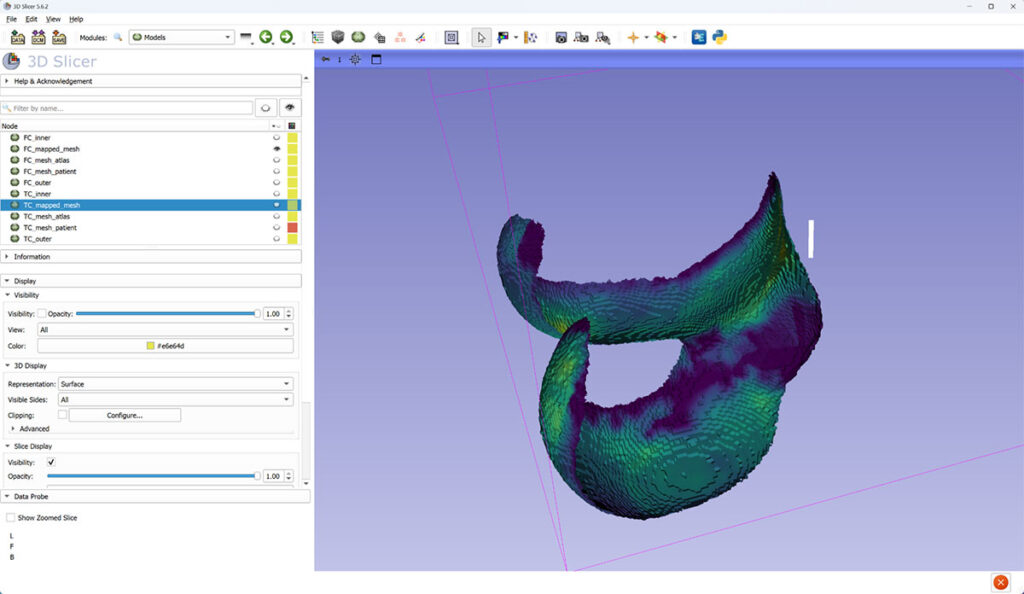 Two different 3D views of femoral cartilage (FC) thickness mapped to canonical mesh.