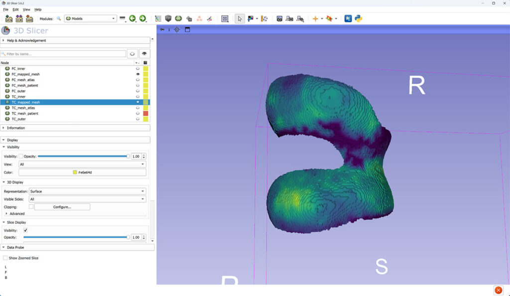 Two different 3D views of femoral cartilage (FC) thickness mapped to canonical mesh.