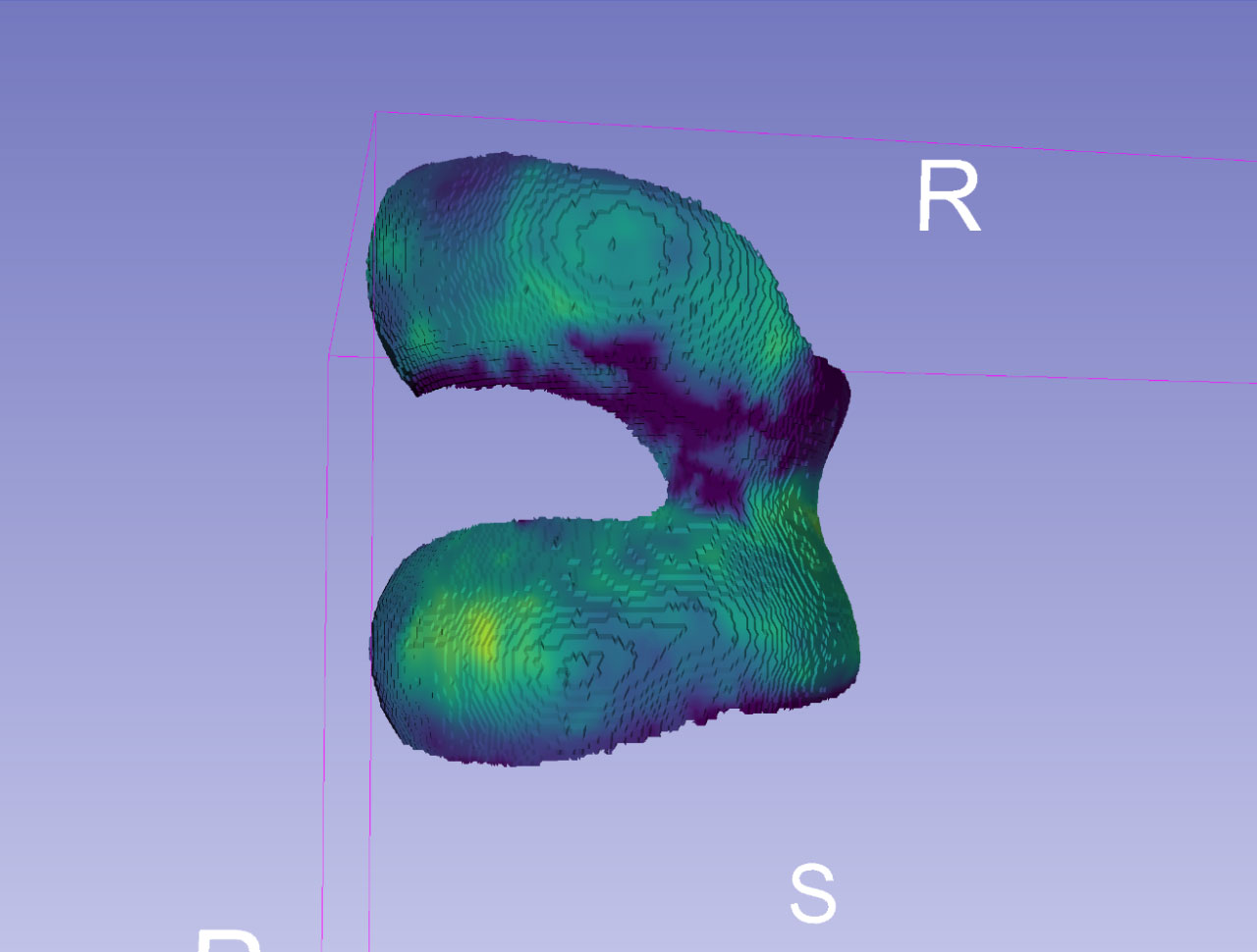 3D views of femoral cartilage (FC) thickness mapped to canonical mesh